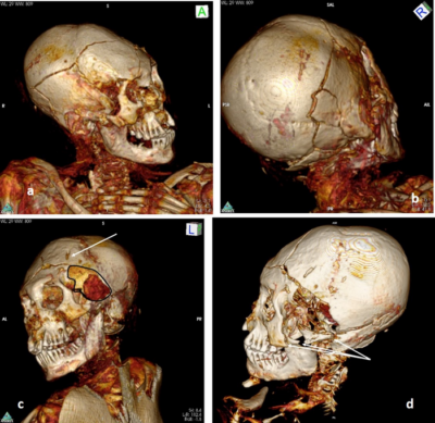 3D CT scan of South African mummies