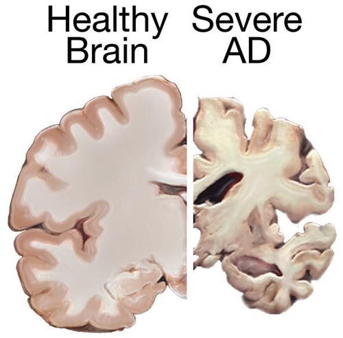Healthy brain compared to a brain suffering from Alzheimer's Disease