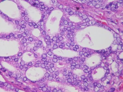Metastatic prostatic adenocarcinoma - prostate cancer cells