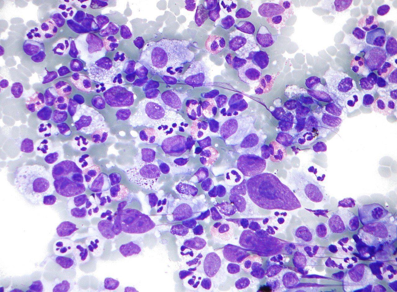 Micrograph of Hodgkin lymphoma cancer cells