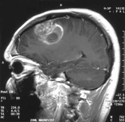 Gliobastoma (astrocytoma) WHO grade IV - MRI sagittal view, post contrast. 15 year old boy