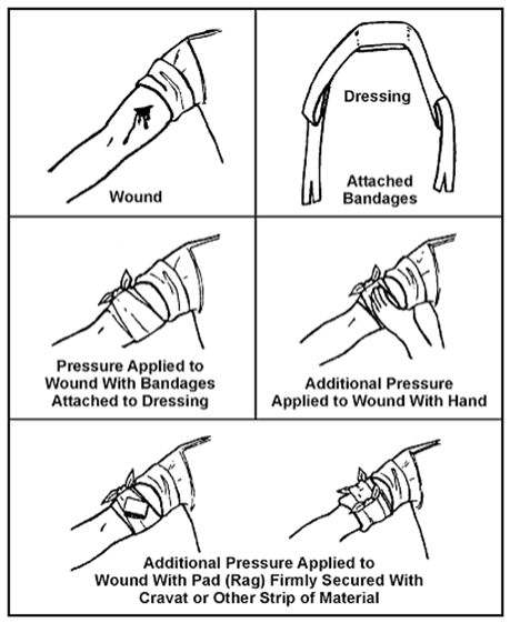 Dressing a bleeding would with direct pressure dressing