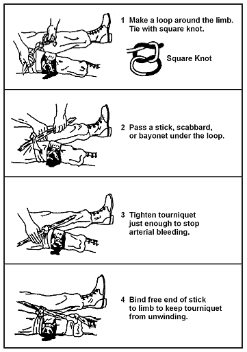 How to create a tournequet