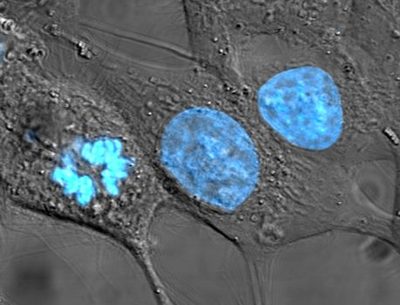 Human cancer cells, specifically HeLa cells, with DNA stained blue and cyan. The central and rightmost cell are in interphase. The cell on the left is going through mitosis and its chromosomes have condensed.