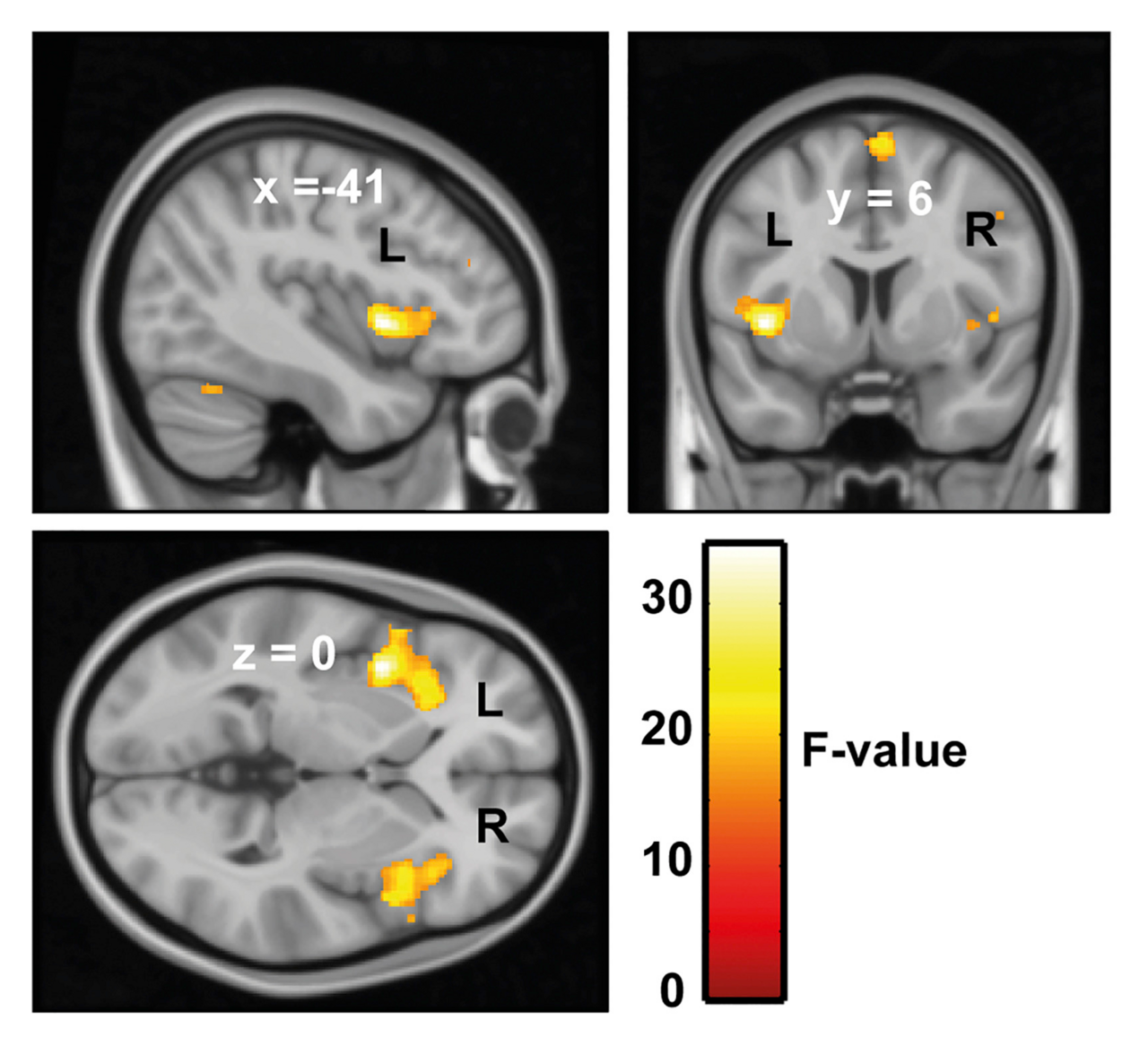 Misophonia and geek life: when everyday sounds suddenly become unbearable 1 Statistical parameter maps (SPMs) representing interaction between group (people with and without misophonia) and sound type (including whether sounds were misophonia trigger sounds) in BOLD responses to hearing sounds