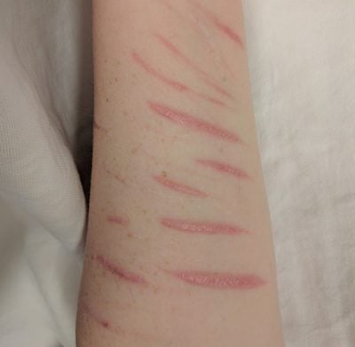 Healed scars from prior self harm - cuts on patient's arm