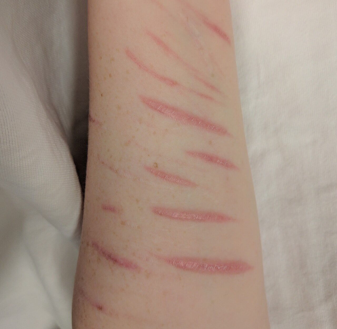Healed scars from prior self harm - cuts on patient's arm